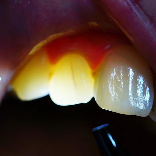 Melectio endolysspids 